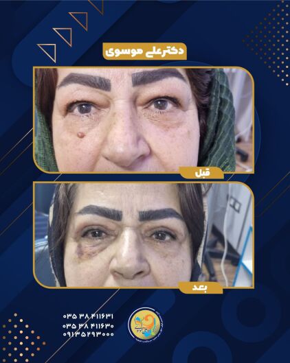 قبل و ده روز بعد از بلفاروپلاستی