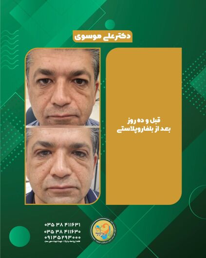عمل بلفاروپلاستی