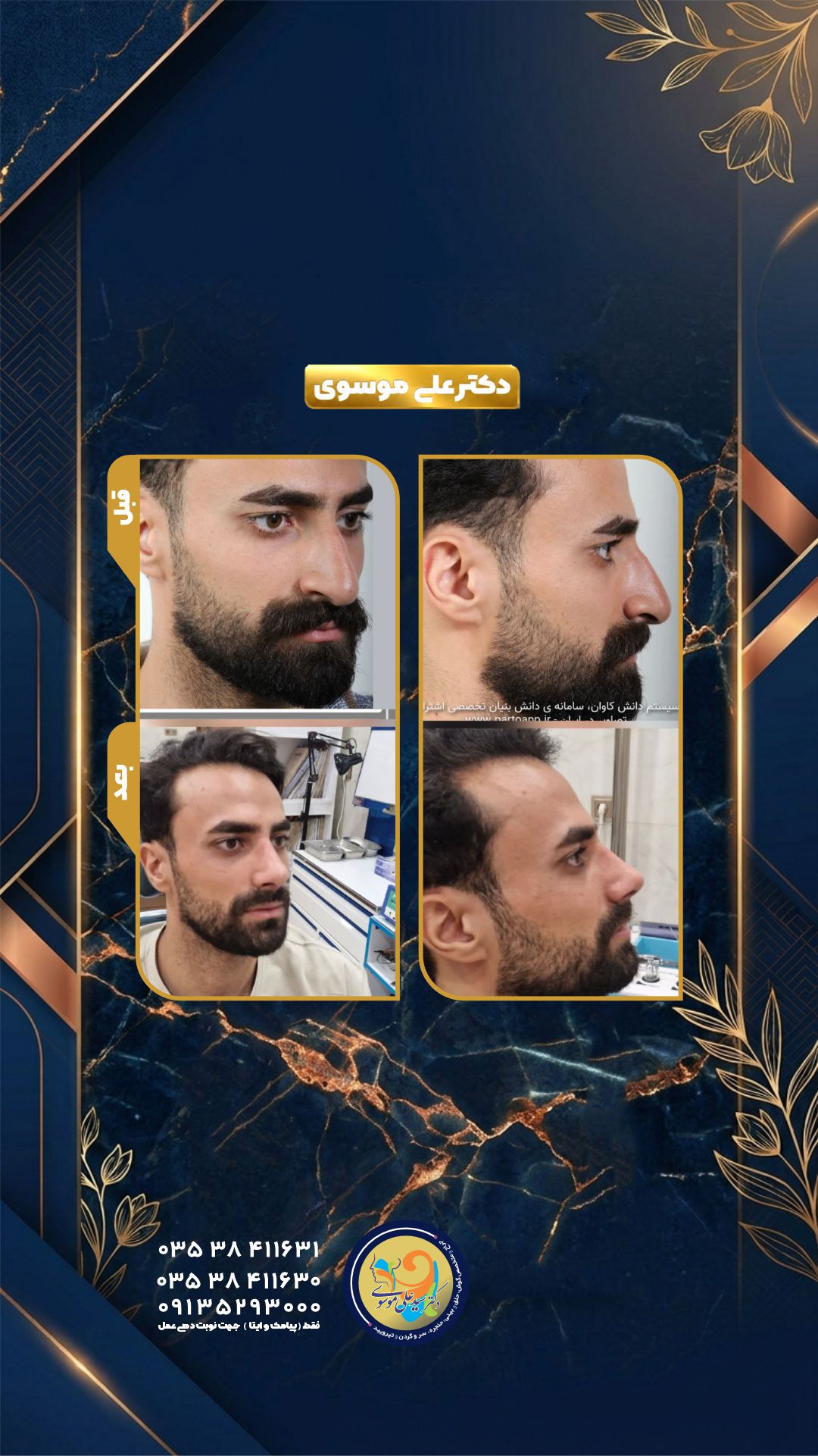 عمل زیبایی بینی یزد 