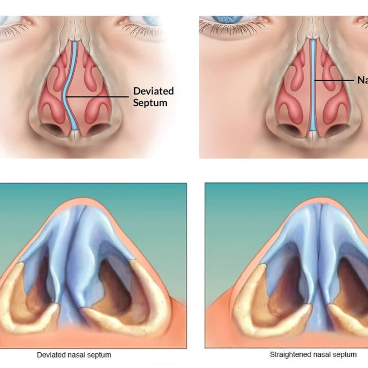 راهنمای مراقبتهای قبل و بعد از جراحی سپتوپلاستی (Septoplasty)