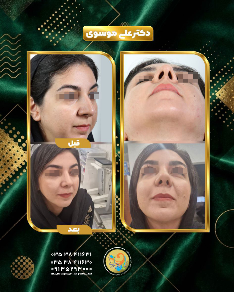 جراحی زیبایی بینی یزد | عمل بینی فوق‌العاده طبیعی به درخواست زیباجو