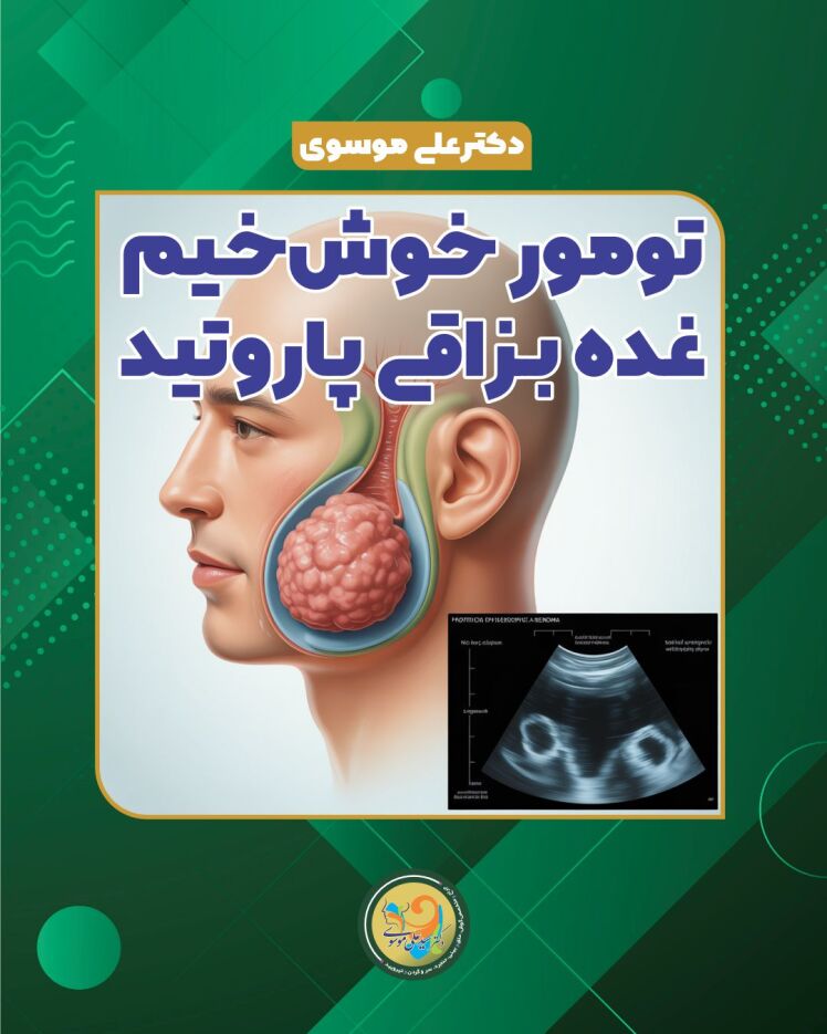 تومور خوشخیم غده پاروتید (آدنوم پلئومورفیک) چیست؟ علائم، تشخیص و درمان