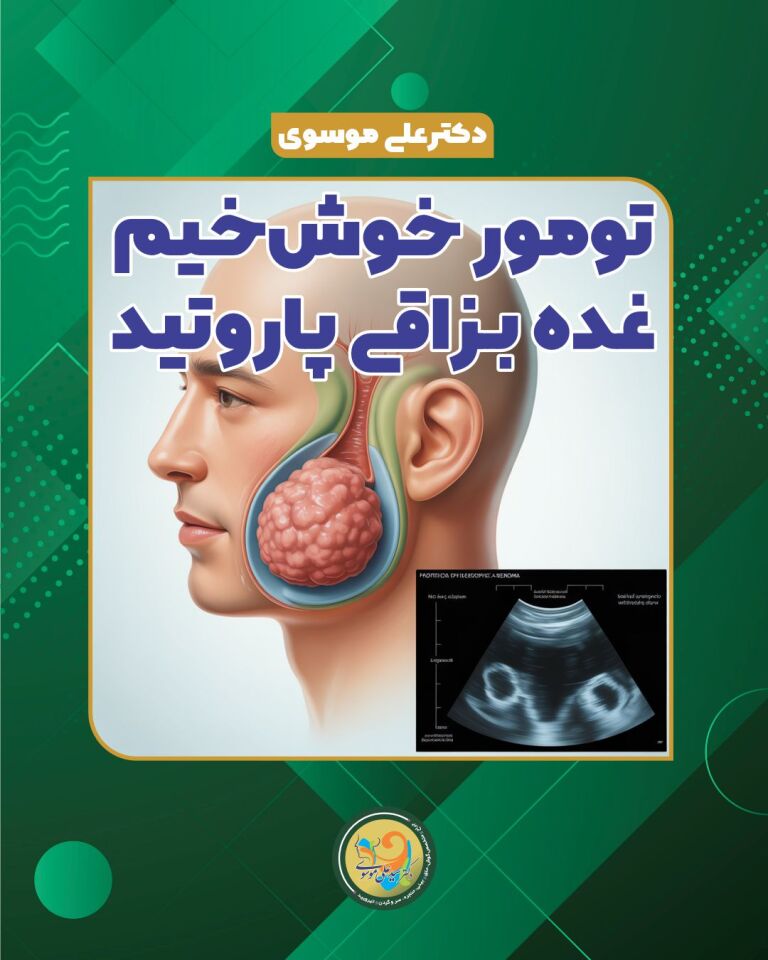 تومور خوش‌خیم غده پاروتید (آدنوم پلئومورفیک) چیست؟ علائم، تشخیص و درمان