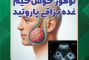 تومور خوشخیم غده پاروتید (آدنوم پلئومورفیک) چیست؟ علائم، تشخیص و درمان