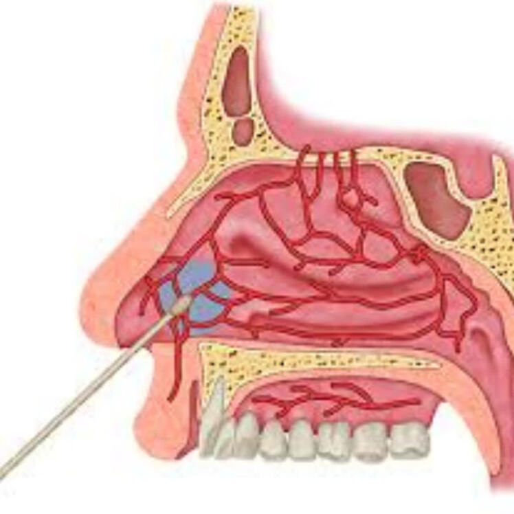راهنمای مراقبتهای قبل و بعد از جراحی کوتر بینی (Nasal Cauterization)
