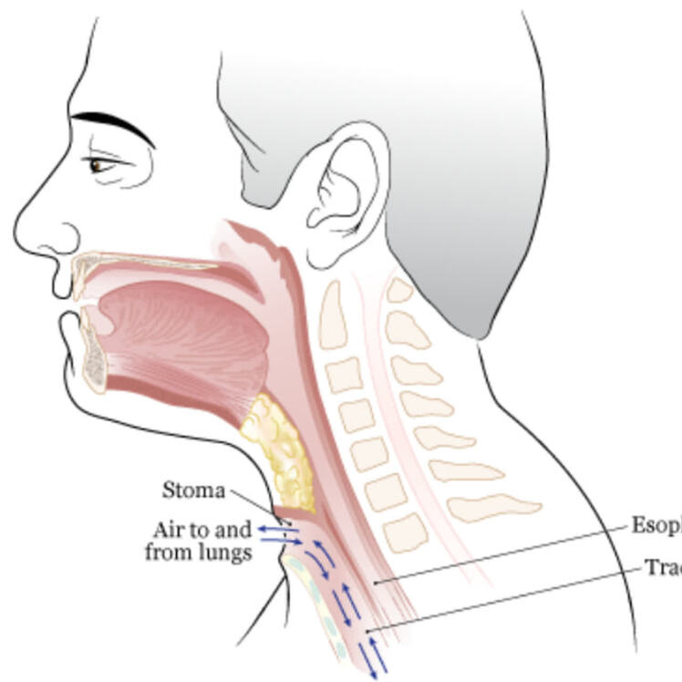 راهنمای مراقبتهای قبل و بعد از جراحی لارنژکتومی (Laryngectomy)
