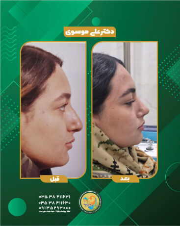 عمل زیبایی بینی یزد
