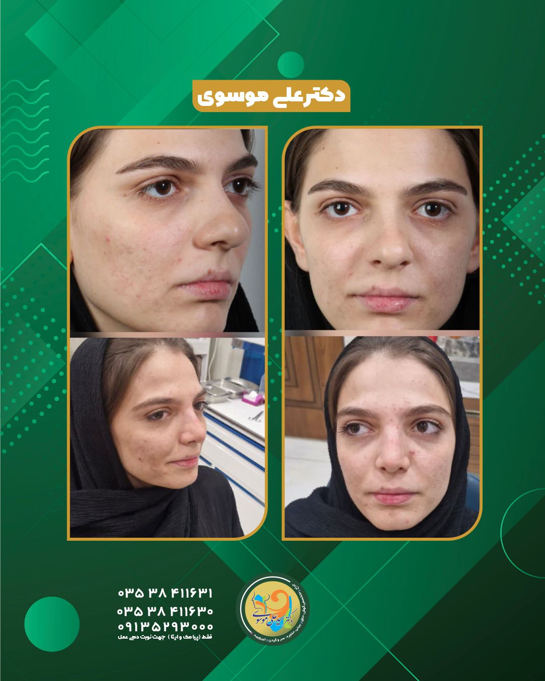  جراحی بینی در یزد