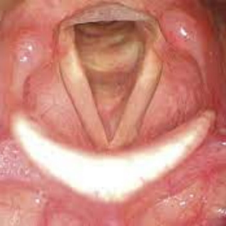 راهنمای مراقبتهای قبل و بعد از لارنگوسکوپی (Laryngoscopy)