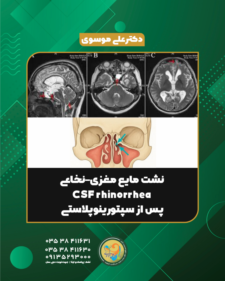 نشت مایع مغزی–نخاعی از بینی (CSF Rhinorrhea): تشخیص، علائم و درمان با اندوسکوپی | دکتر سید علی موسوی
