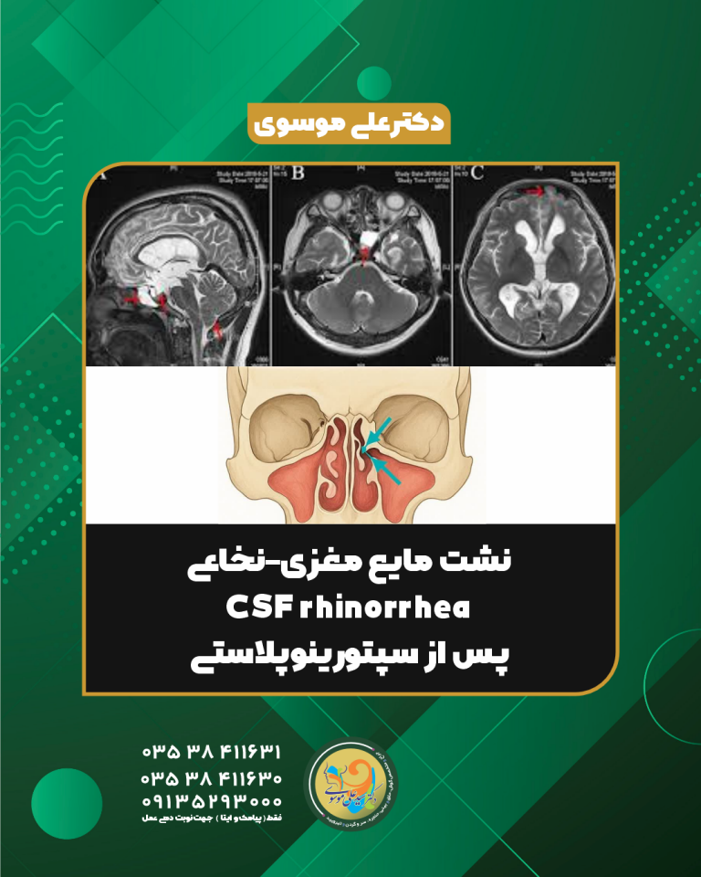 نشت مایع مغزی–نخاعی از بینی (CSF Rhinorrhea): تشخیص، علائم و درمان با اندوسکوپی | دکتر سید علی موسوی 