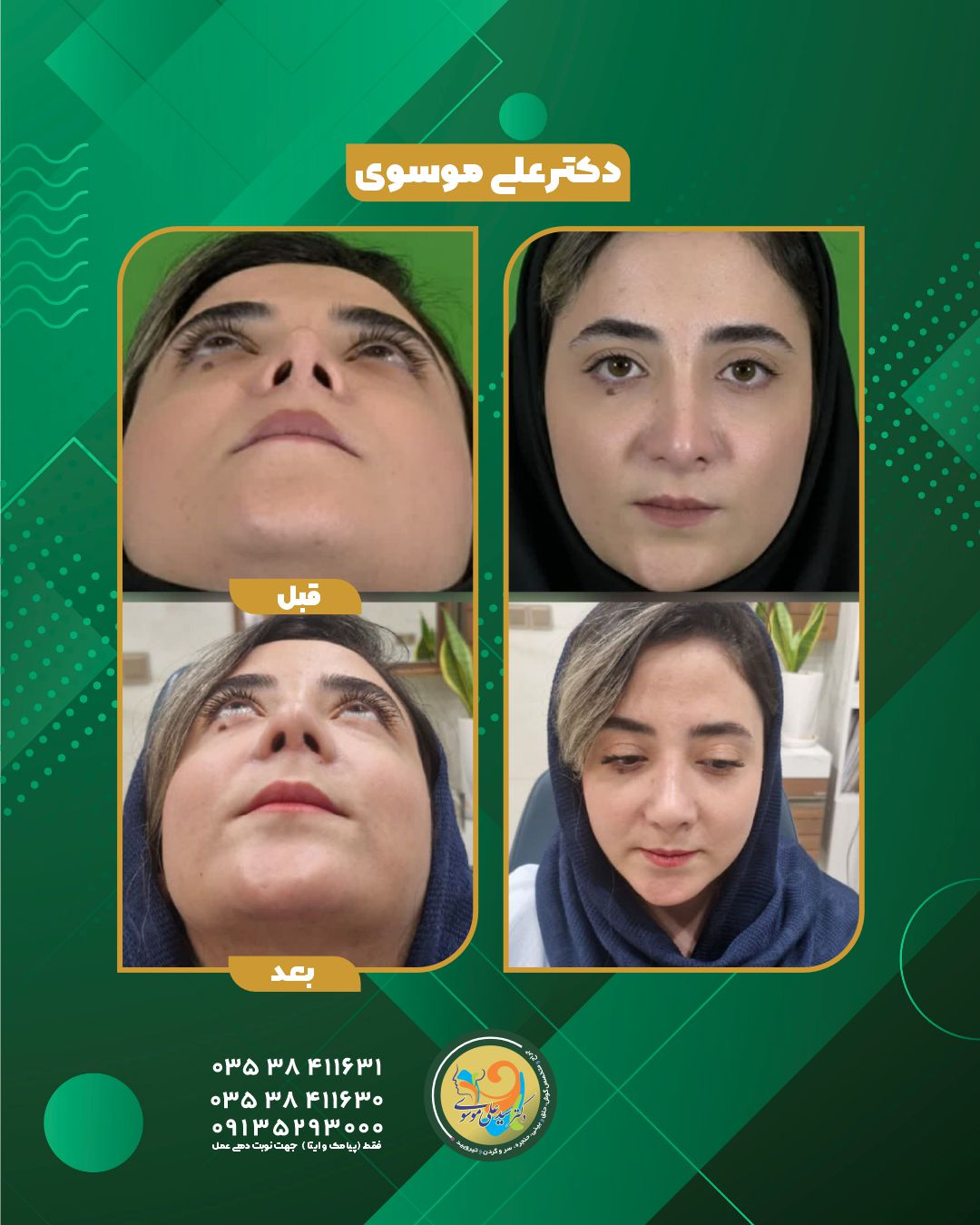 عمل زیبایی بینی در یزد 