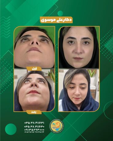 قبل و دوماه بعد از عمل ترمیم رینوپلاستی با غضروف گوش