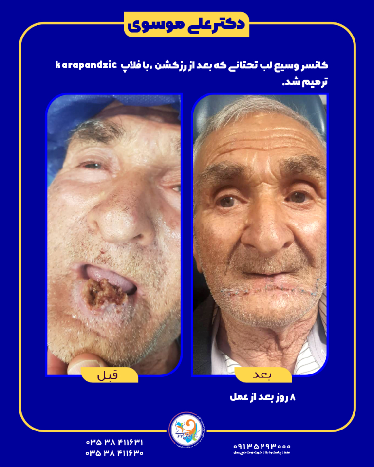 کانسر وسیع لب تحتانی و ترمیم آن با فلاپ Karapandzic رویکردی مؤثر در جراحی انکولوژیک و بازسازی لب