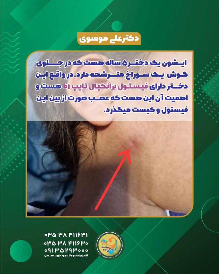 فیستول های مادرزادی سر و گردن در کودکان – معرفی، علائم و درمان قطعی