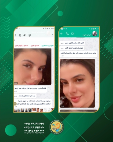عمل زیبایی بینی یزد 