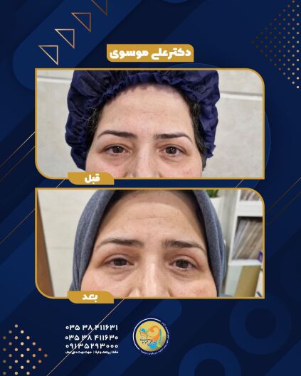 قبل و بعد از بلفاروپلاستی