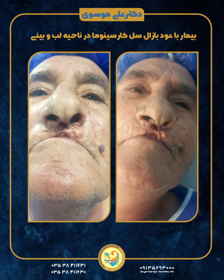 بیمار با عود بازال سل کارسینوما در ناحیه لب و بینی