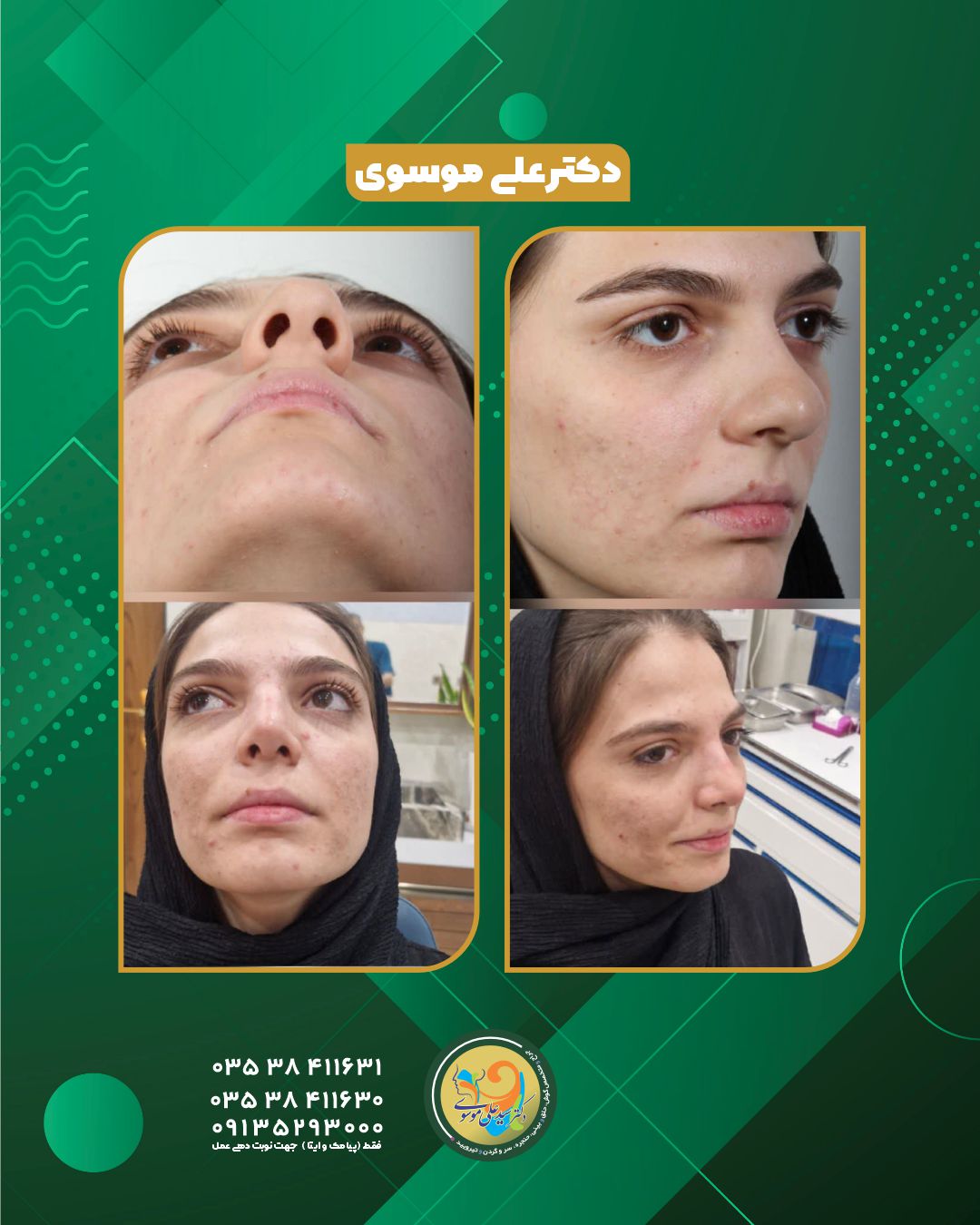  جراحی بینی در یزد