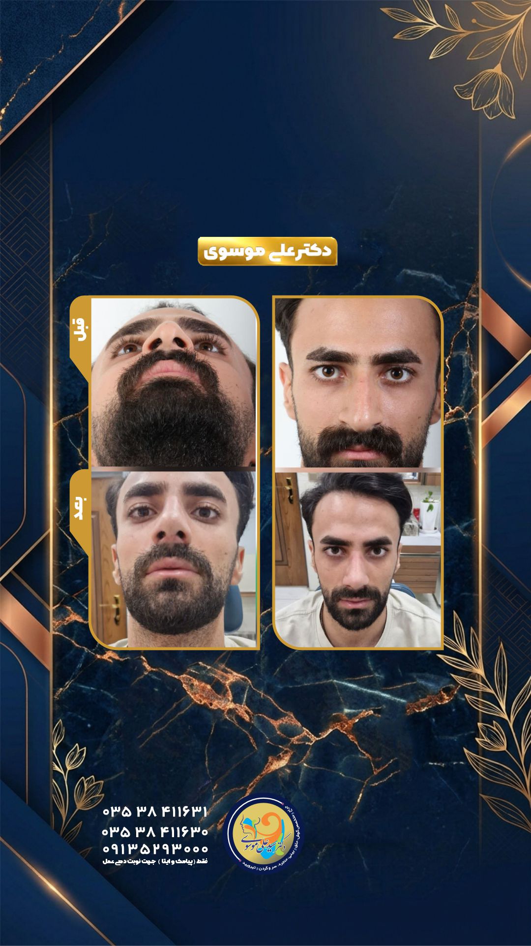 عمل زیبایی بینی در یزد 