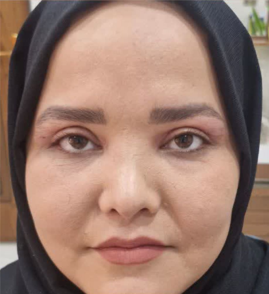 بعد از عمل بلفاروپلاستی