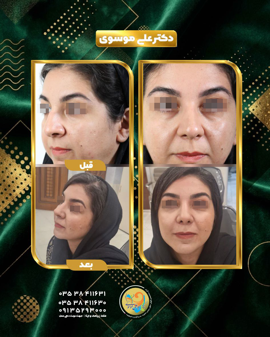 جراحی زیبایی بینی یزد | عمل بینی فوق‌العاده طبیعی به درخواست زیباجو