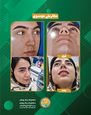 قبل و یکسال بعد از عمل زیبایی بینی