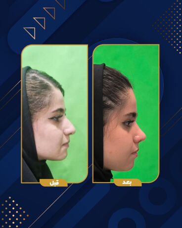 نمونه قبل و بعد جراحی بینی در یزد