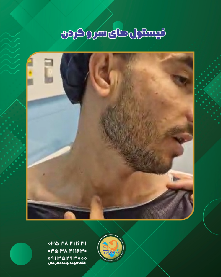 فیستول های مادرزادی سر و گردن: علائم، انواع و درمان قطعی