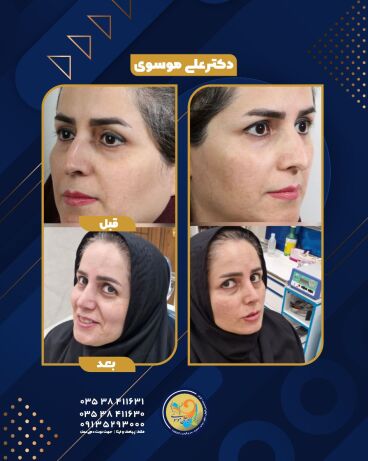 قبل و دوماه ماه بعد از رینوپلاستی