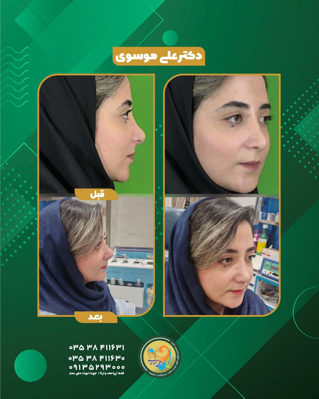 جراحی زیبایی بینی در یزد 