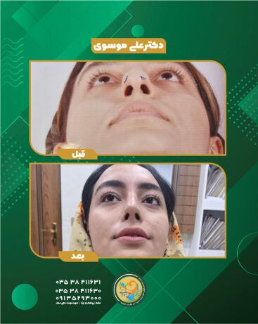 عمل زیبایی بینی یزد