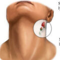 جراحی سر وگردن در یزد نمونه کارهای جراحی حلق و گلو دکتر سید علی موسوی در یزد