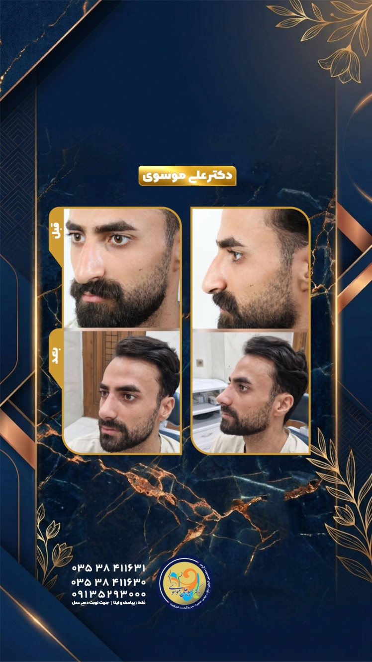 عمل زیبایی بینی در یزد؛ قبل و ۳ ماه بعد از رینوپلاستی یک آقای جوان