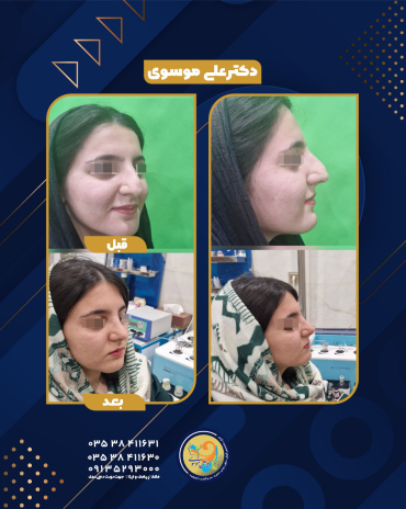 عمل بینی یزد 