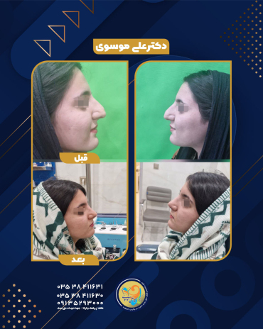 عمل بینی یزد 