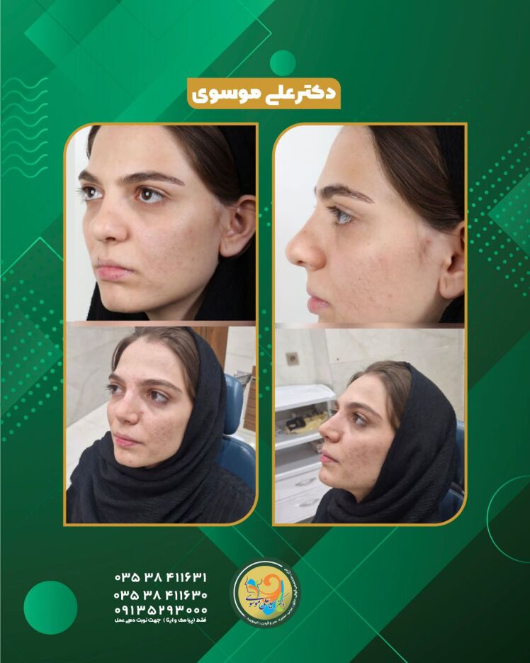 قبل و دو ماه بعد از عمل رینوپلاستی بینی کج؛ نتیجه جراحی بینی در یزد چگونه است؟