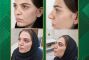 قبل و دو ماه بعد از عمل رینوپلاستی بینی کج؛ نتیجه جراحی بینی در یزد چگونه است؟