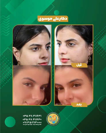  عمل زیبایی بینی یزد 